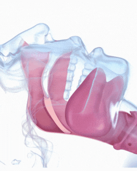 snoring device entering mouth and improving breathing