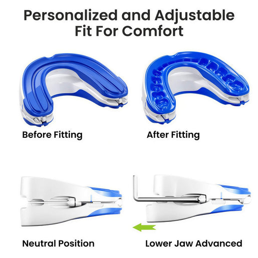 Custom snoring device