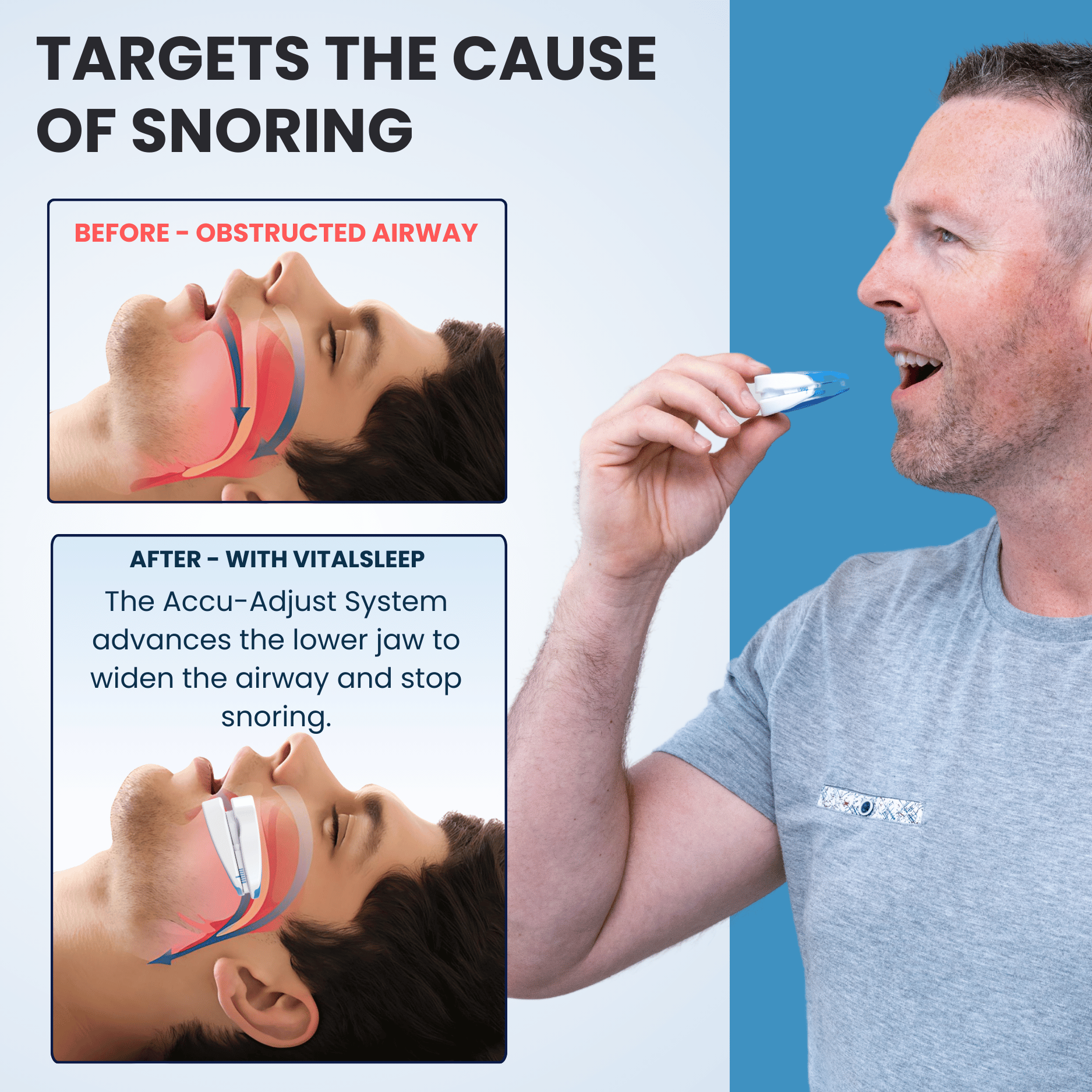 Man holding a custom-fit snoring mouthpiece