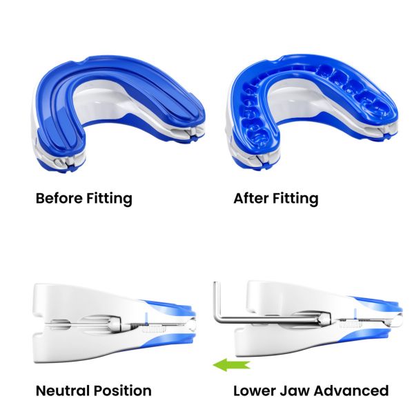 adjustable snoring device for snorers