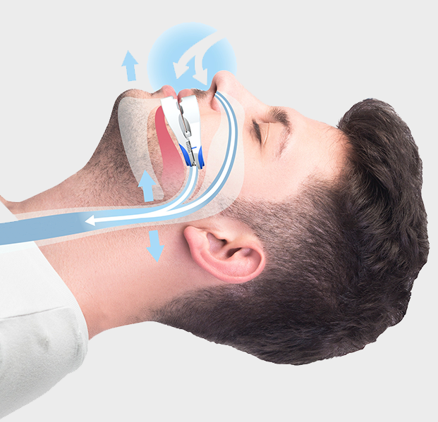 airway opening oral appliance
