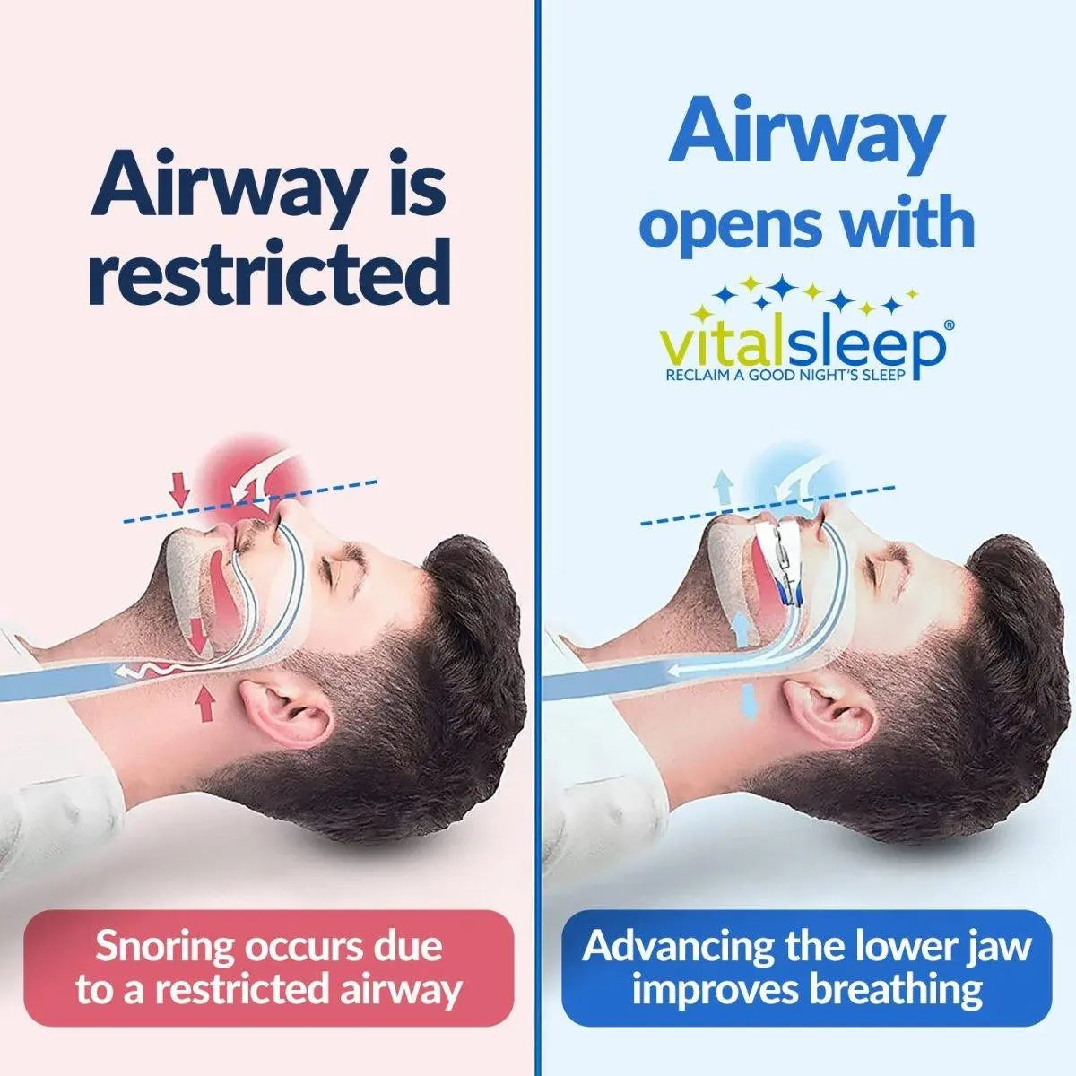 mouthpiece-opening-airway