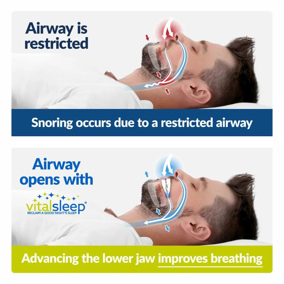 VitalSleep Mouthpiece For Snoring - Extra Savings - VitalSleep
